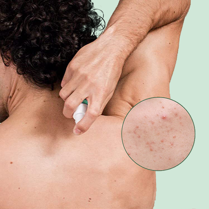 MEDIx™ Spray de traitement de l'acné du dos – the Skinical